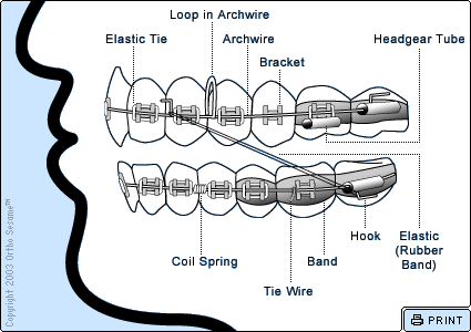 Parts of Your Braces